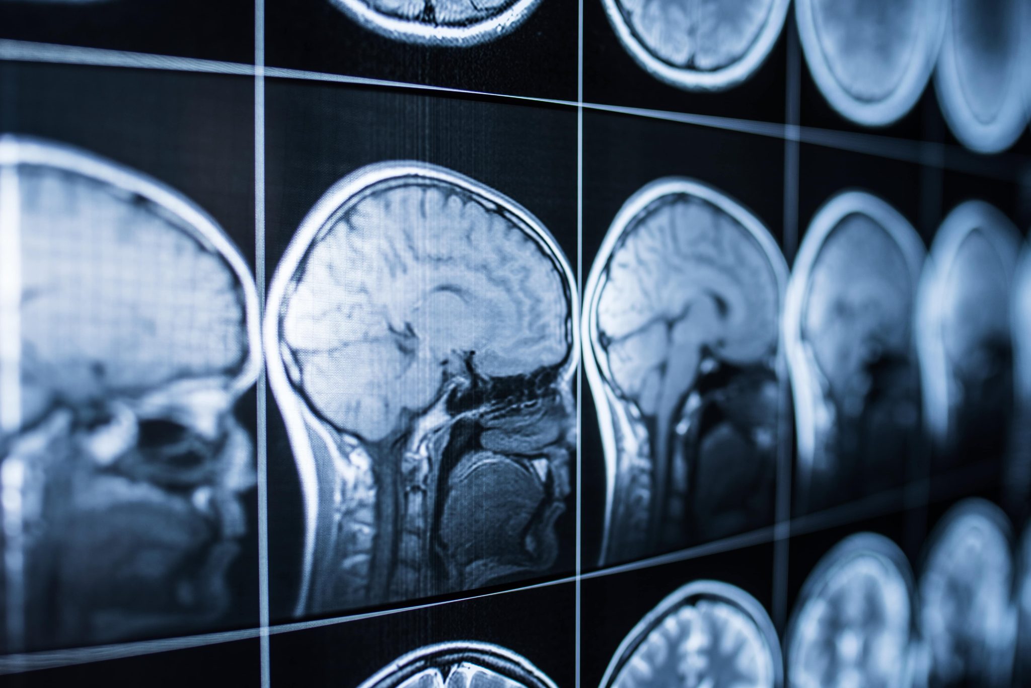diagnoising a traumatic brain injury